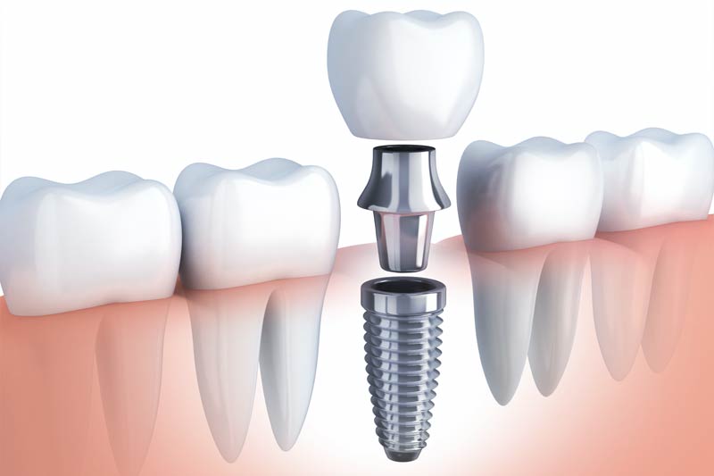 Implants Dentist in Irving