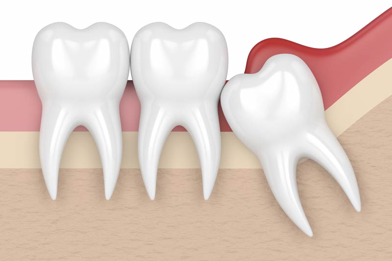 Wisdom Tooth Removal in Irving